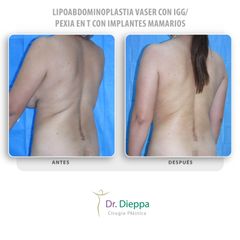 Lipoabdominoplastia Vaser - Cirugía Plástica Dieppa