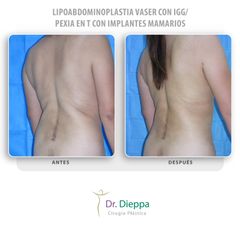 Lipoabdominoplastia Vaser - Cirugía Plástica Dieppa