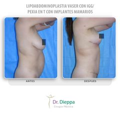 Lipoabdominoplastia Vaser - Cirugía Plástica Dieppa
