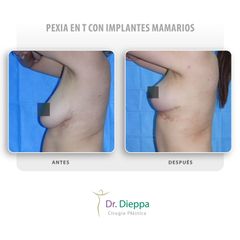 Mastopexia - Cirugía Plástica Dieppa
