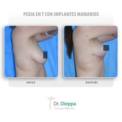 Mastopexia - Cirugía Plástica Dieppa