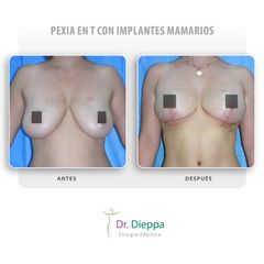Mastopexia - Cirugía Plástica Dieppa