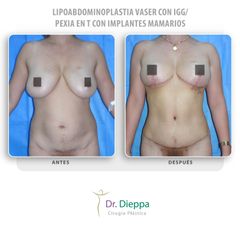 Lipoabdominoplastia Vaser - Cirugía Plástica Dieppa