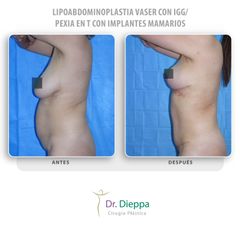Lipoabdominoplastia Vaser - Cirugía Plástica Dieppa