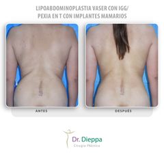 Lipoabdominoplastia Vaser - Cirugía Plástica Dieppa