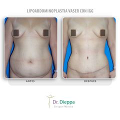 Lipoabdominoplastia vaser con IGG - Cirugía Plástica Dieppa