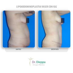 Lipoabdominoplastia vaser con IGG - Cirugía Plástica Dieppa