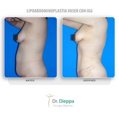 Lipoabdominoplastia vaser con IGG - Cirugía Plástica Dieppa