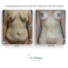 Lipoabdominoplastia con IGG  Pexia en T con implantes - Cirugía Plástica Dieppa