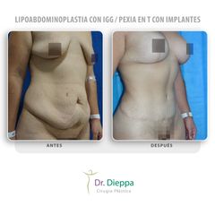 Lipoabdominoplastia con IGG  Pexia en T con implantes - Cirugía Plástica Dieppa