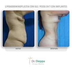 Lipoabdominoplastia con IGG  Pexia en T con implantes - Cirugía Plástica Dieppa