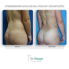 Lipoabdominoplastia con IGG  Pexia en T con implantes - Cirugía Plástica Dieppa