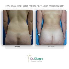 Lipoabdominoplastia con IGG  Pexia en T con implantes - Cirugía Plástica Dieppa