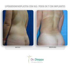 Lipoabdominoplastia con IGG  Pexia en T con implantes - Cirugía Plástica Dieppa