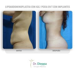 Lipoabdominoplastia con IGG  Pexia en T con implantes - Cirugía Plástica Dieppa