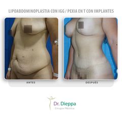 Lipoabdominoplastia con IGG  Pexia en T con implantes - Cirugía Plástica Dieppa