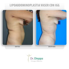 Lipoabdominoplastia vaser con IGG - Cirugía Plástica Dieppa