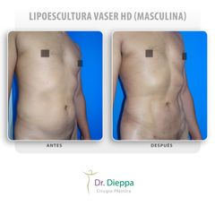 Lipoescultura Vaser HD (masculina)