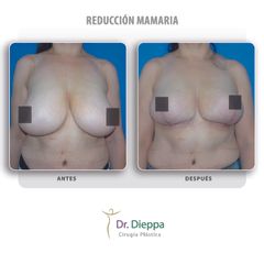 Reducción Mamaria - Cirugía Plástica Dieppa