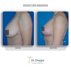Reducción Mamaria - Cirugía Plástica Dieppa