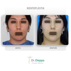 Mentoplastia - Cirugía Plástica Dieppa