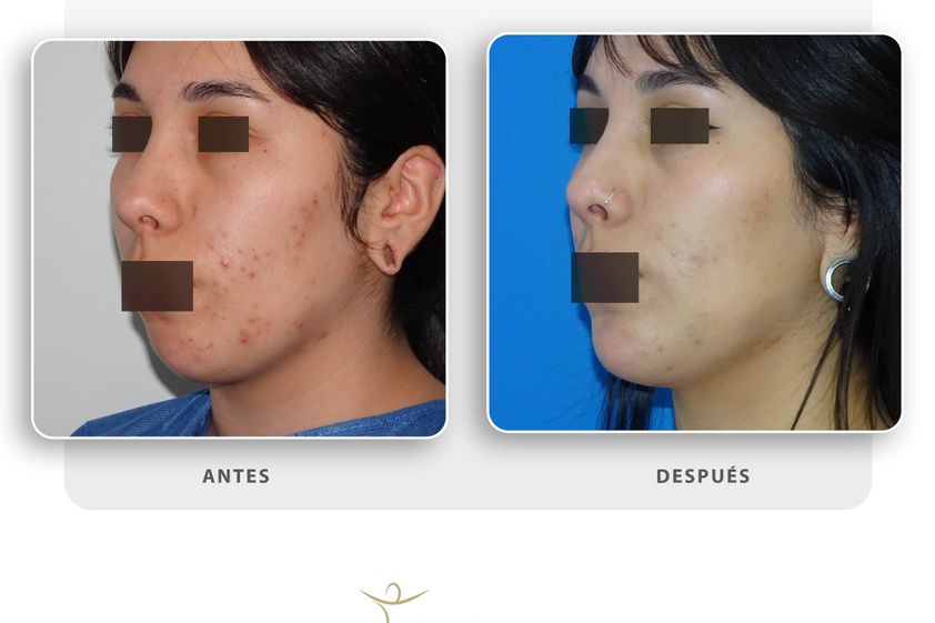 Mentoplastia antes y después - 863382