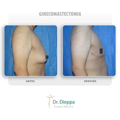 Ginecomastectomia - Cirugía Plástica Dieppa