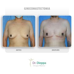 Ginecomastectomia - Cirugía Plástica Dieppa