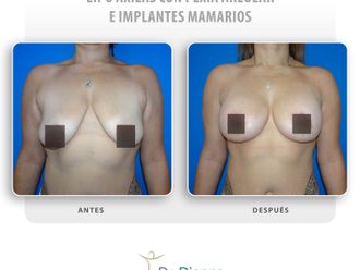 Mastopexia antes y después - 863386