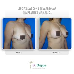 Mastopexia con implantes - Cirugía Plástica Dieppa