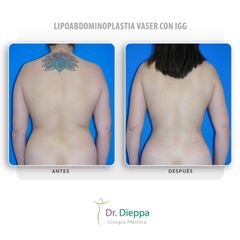 Lipoabdominoplastia vaser con IGG - Cirugía Plástica Dieppa