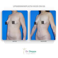 Lipoabdominoplastia vaser con IGG - Cirugía Plástica Dieppa