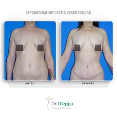 Lipoabdominoplastia vaser con IGG - Cirugía Plástica Dieppa
