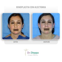 Rinoplastia con alectomia - Cirugía Plástica Dieppa