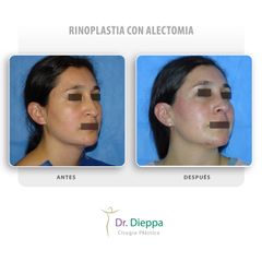 Rinoplastia con alectomia - Cirugía Plástica Dieppa