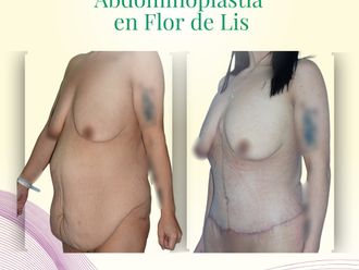 Abdominoplastía antes y después - 871187