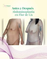 Abdominoplastia - Cirugía Plástica Dieppa