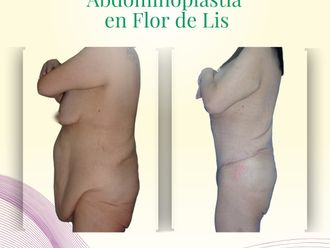 Abdominoplastía antes y después - 871188