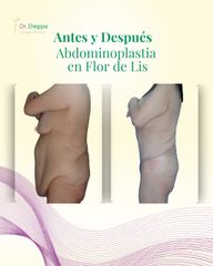 Abdominoplastia - Cirugía Plástica Dieppa