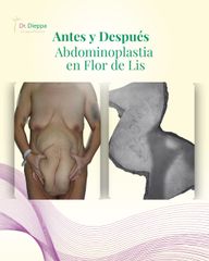 Abdominoplastia - Cirugía Plástica Dieppa