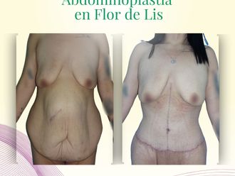 Abdominoplastía antes y después - 871190