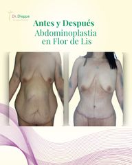 Abdominoplastia - Cirugía Plástica Dieppa