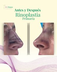 Rinoplastia - Cirugia Plástica Dieppa