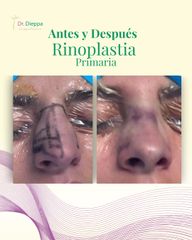 Rinoplastia - Cirugia Plástica Dieppa