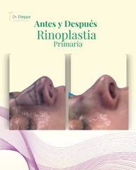 Rinoplastía - Cirugia Plástica Dieppa