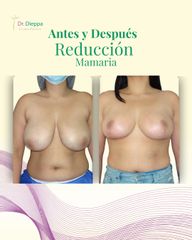 Reducción Mamaria - Cirugía Plástica Dieppa