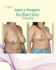 Aumento Mamario - Cirugía Plástica Dieppa