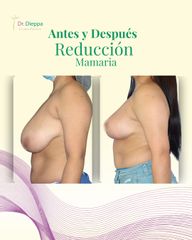 Reducción Mamaria - Cirugía Plástica Dieppa