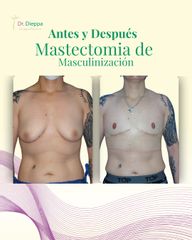 Mastectomía de masculinización -Cirugía Plástica Dieppa