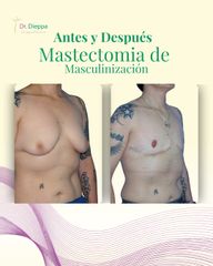 Mastectomía de masculinización